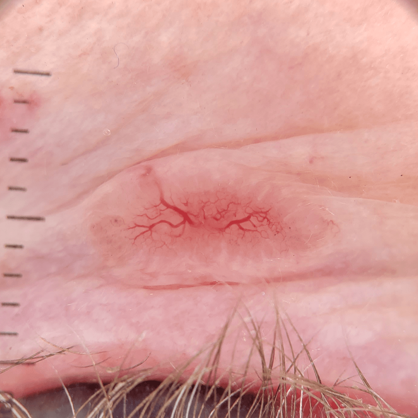 Ilustração de um Carcinoma Basocelular